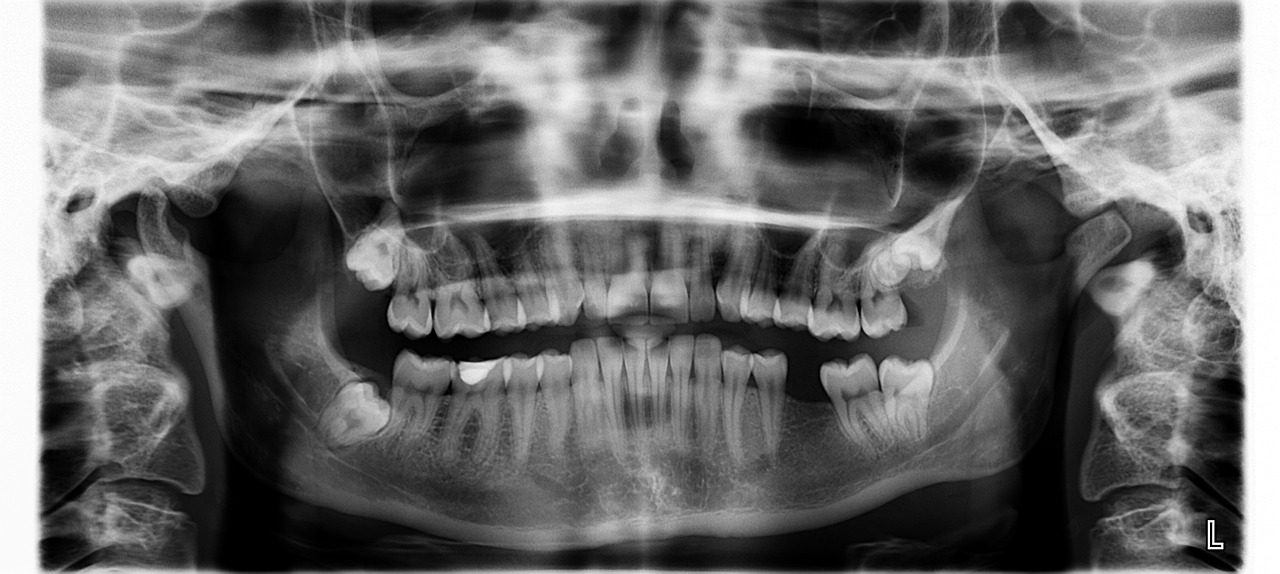 x ray, teeth, tooth is missing